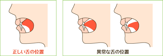 お口のトレーニング 高津区溝の口予防小児歯科 かわべ歯科キッズプラス